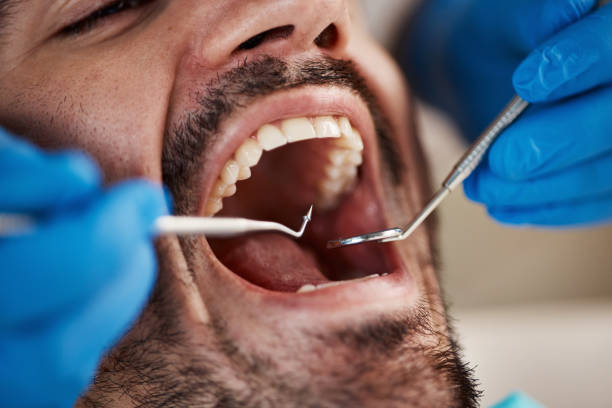 Best Emergency Dentist for Lost Fillings or Crowns in Livingston, MT